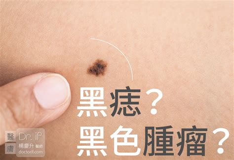 陰囊有痣|陰囊上的痣：正常嗎？該去看皮膚科嗎？